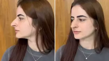 Hevesle burun estetiği oldu ama sonu skandal