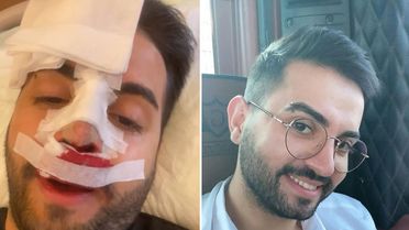 Kadir Ezildi burnu sargılı fotoğrafıyla korkuttu! Gerçek sonradan ortaya çıktı