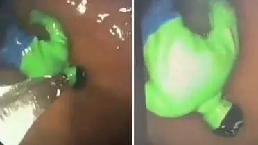 Hindistan'da çocuğun midesinden 'hulk' çıktı