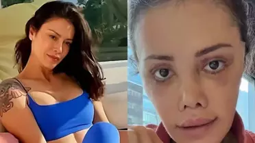 Yüz nakli yaptıran Didem Ceran'ın son hali: Harika gözüküyorum