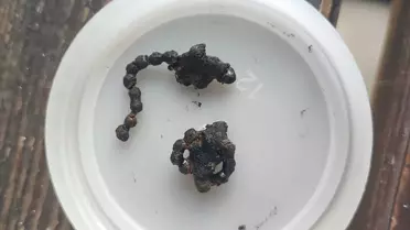 Rize'de 5 Yaşındaki Çocuğun Burnundaki Metal Zincir Çıkarıldı