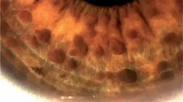 Nörofibromatozis Tip 1 Tanısı OCT ile Daha Kolay ve Başarılı