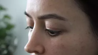 Göz Kapağı İşleminde Kalıcı Hasar