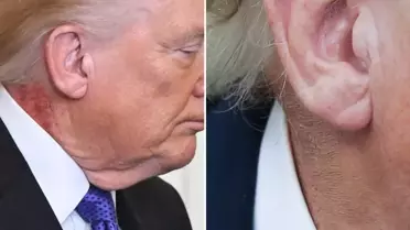 Trump'ın boynundaki kızarıklığı gizleme çabası
