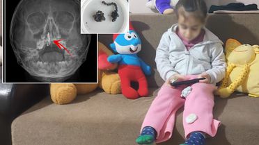 5 yaşındaki Polen yıllarca böyle yaşamış! Burnundan ameliyatla çıkardılar