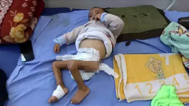 Gazze'de Çocuklar Yetersiz Beslenmeyle Mücadele Ediyor