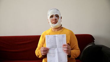 Güzellik Merkezine Şikayet: Yüzünde Yanık