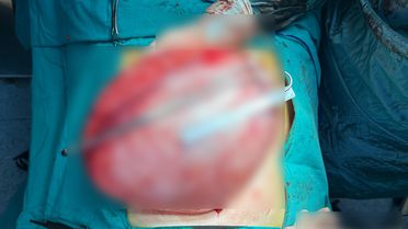 Bolu'da 14 Yaşındaki Kızın Karnında Kist Bulundu