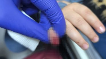 AVM'de yürüyen merdivene eli sıkışan çocuğun parmağı koptu