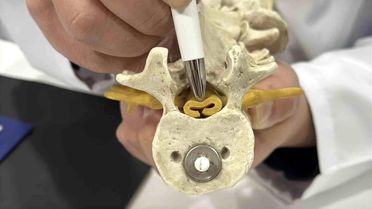 Omurga Daralması Belirtileri ve Tedavi Yöntemleri