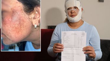 Prenses cilt bakımı yüzünü yaktı: Oğlum 'öcü' deyip benden kaçıyor