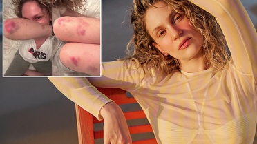 Farah Zeynep Abdullah'ın vücudundaki morluklar korkuttu
