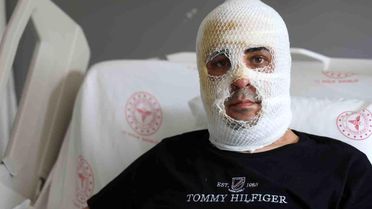 Ekmek teknesi küle dönmesin diye mücadele eden esnafın yüzü ve vücudu yaşanan patlamayla yandı