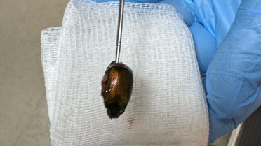 Kulağındaki ağrının nedeni şaşkına çevirdi! Doktorlar Japon böceği çıkardı