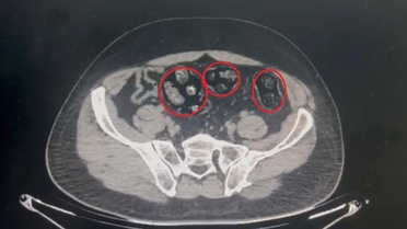 Mide ve bağırsaklarından yarım kilo uyuşturucu çıktı