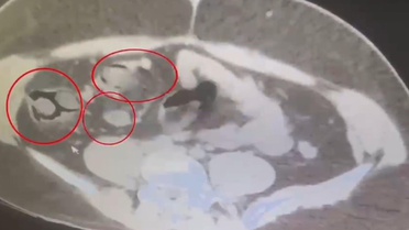 Kars'ta İranlı kuryenin midesinden 571 gram metamfetamin çıktı