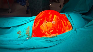 Halsizlik şikayetiyle hastaneye gitti, karnından 6,5 kilogramlık tümör çıktı