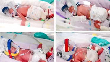 Avustralya'da bir kadın doğal yolla gebelik sonucu tek yumurta dördüzleri dünyaya getirdi