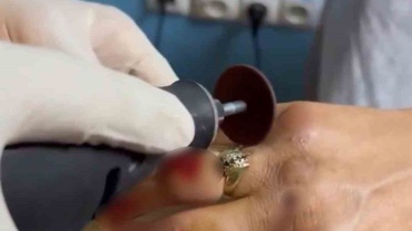 Yüzük, İtfaiye Ekipleri Tarafından Kesilerek Çıkarıldı