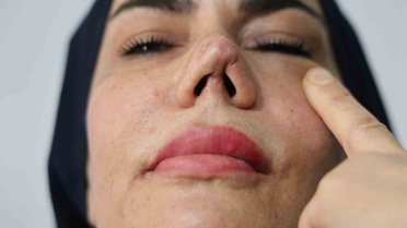 Burun estetiği faciayla sonuçlandı: Kadının hayatı kabusa döndü