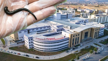 Boğaz ağrısıyla acile giden hastada şaşırtan teşhis: Ses tellerinin arkasında canlı sülük