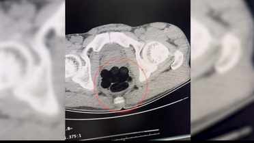 Narkotik ekipleri otobüsü durdurdu, şüphelinin midesinden 253 gram eroin çıktı