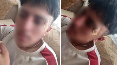 İddia vahim! Öğretmenin kafa attığı çocuğun burnu kırıldı