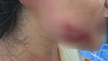 Diyarbakır'da maç sonrası havai fişek 7. kat balkonunda patladı, 2 kardeş yaralandı