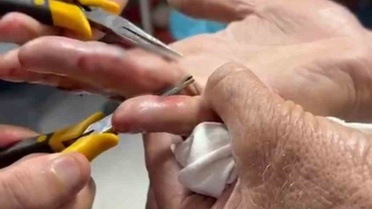 Yaşlı adamın parmağına sıkışan yüzük Batman'da doktor gözetiminde çıkarıldı