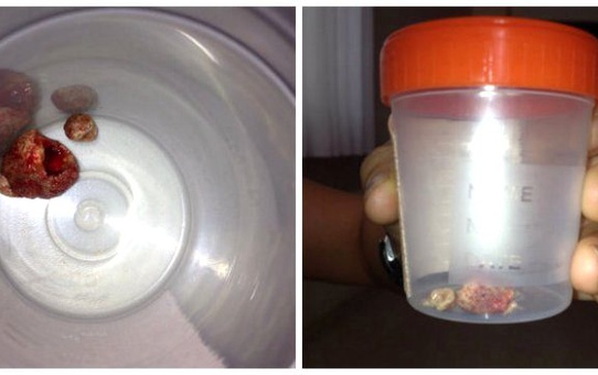 Tükürük Bezinde 3cm Çapında Taş Çıkartıldı