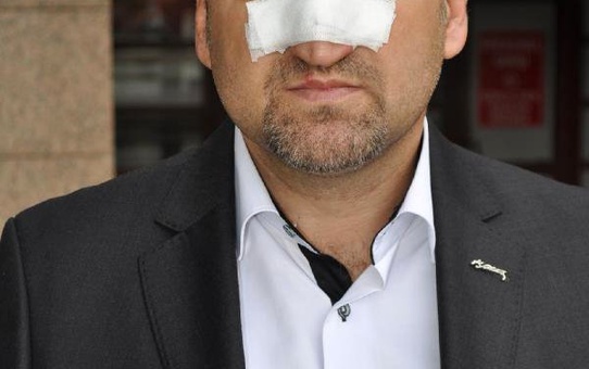 Öğretmenin Burnunu Kıran Belediye Başkan Yardımcısına Başka Bir Birimde Memurluk Görevi Verildi