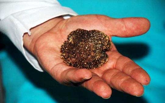 Mesanesinde 220 gramlık tek parça taş çıktı
