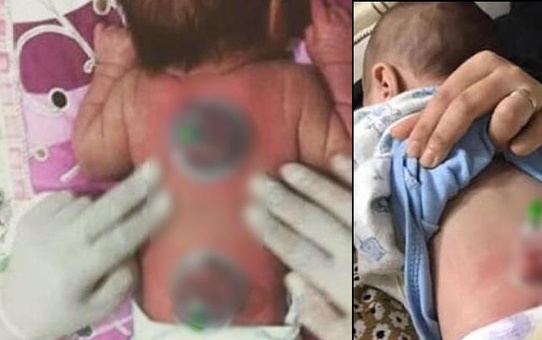 2 aylık bebeğe hacamat yapılan görüntülerin tepki toplaması üzerine uzmanlardan uyarı: Çocuklara asla yapılmamalı