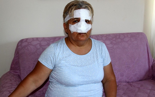 Parkta pitbull dehşeti! Kadının burnunun ucunu kopardı, ortalık kan gölüne döndü