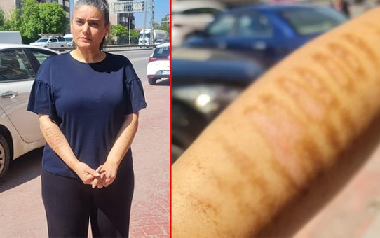 Evlilik arifesindeki genç kadın güzellik merkezinde kâbusu yaşadı: Bu kollarla nasıl gelinlik giyeceğim?