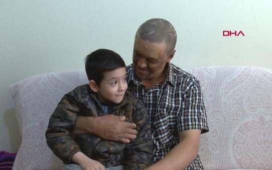 Yangında yaralanan ve dış görünüşü nedeniyle iş bulamayan adamın hikayesi