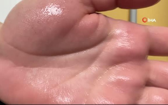Uzmanı tedavisini anlattı: 'Aşırı terlemenin etkili ve kalıcı tedavisi mümkün'