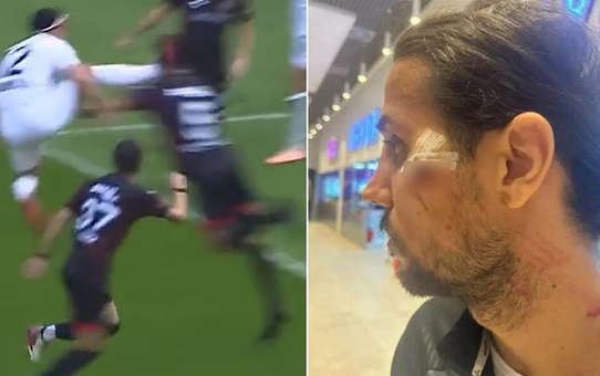 Futbolcuyu tanınmaz hale getiren faul sonrası hakemin verdiği kart olay oldu! Tepkiler çığ gibi