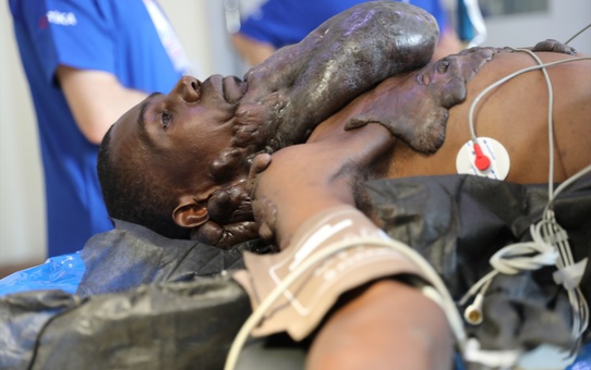 Uganda'da Türk Doktorlardan Keloid Ameliyatı