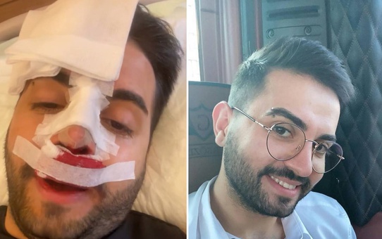 Kadir Ezildi burnu sargılı fotoğrafıyla korkuttu! Gerçek sonradan ortaya çıktı