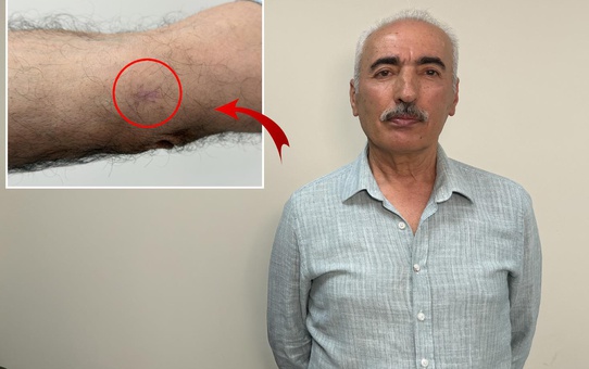 Kolundaki 1 santimetrelik yara kanser çıktı