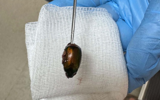 Kulağındaki ağrının nedeni şaşkına çevirdi! Doktorlar Japon böceği çıkardı