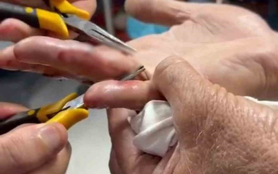 Yaşlı adamın parmağına sıkışan yüzük Batman'da doktor gözetiminde çıkarıldı