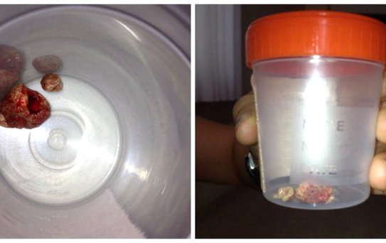 Tükürük Bezinde 3cm Çapında Taş Çıkartıldı