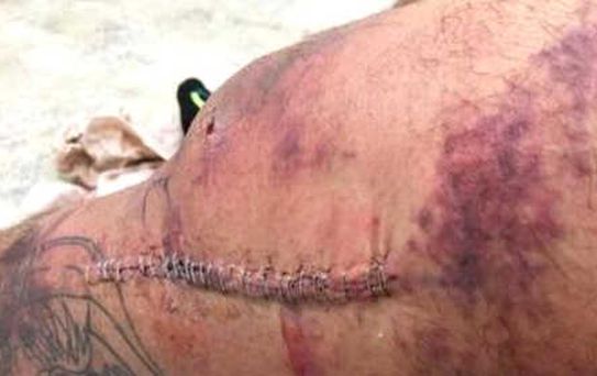 Dünyaca Ünlü Dövüşçünün Sakatlığı Sonrası Bacağına 31 Dikiş Atıldı
