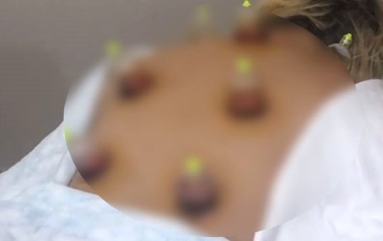 Ünlü Şarkıcı Yeliz Yeşilmen, Hacamat Yaptırdı