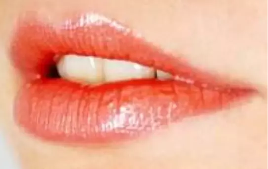 Ameliyatsız eros yayı estetiği