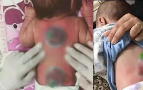 2 aylık bebeğe hacamat yapılan görüntülerin tepki toplaması üzerine uzmanlardan uyarı: Çocuklara asla yapılmamalı