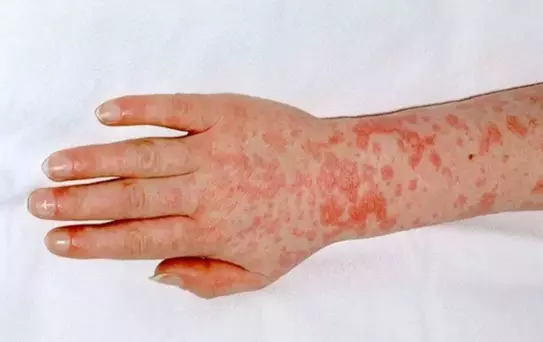 Yunanistan'da Strep-A bakterisi nedeniyle okullar kapatıldı