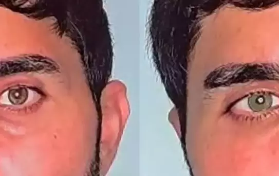 Göz Rengi Değiştirme Artık Mümkün!